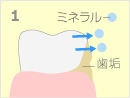 1.歯の表面（エナメル質）が溶け出し、初期のむし歯が発生した状態のイメージイラスト