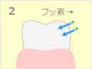 2.フッ素を塗布すると、フッ素が歯の表面に吸着されるイメージイラスト