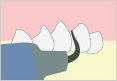 歯石・歯垢の除去