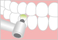 歯石・歯垢の除去