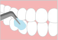 歯石・歯垢の除去